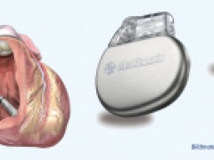 Sondenloser Herzschrittmacher bei ersten Patienten erfolgreich eingesetzt