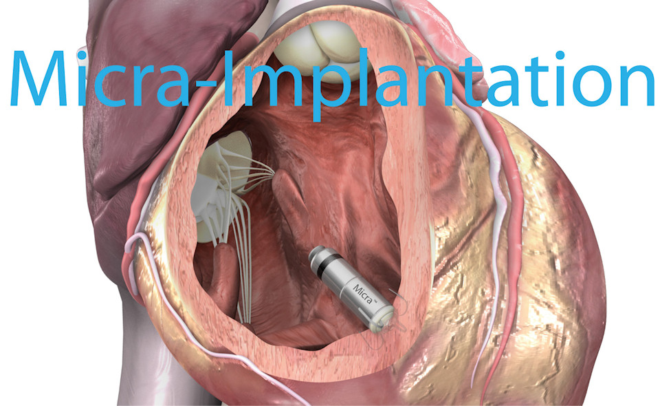 Device-Implantation (Therapie mit Herzschrittmacher / ICD / CRT / Eventrecorder)