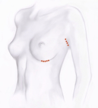 Brustvergrößerung (Augmentation)