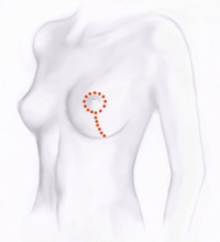 Brustverkleinerung (Mammareduktion)